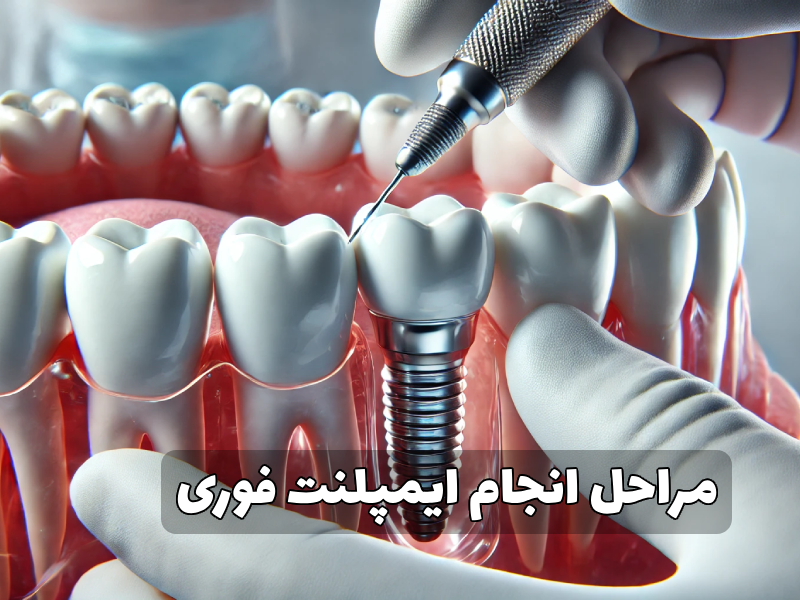مراحل انجام ایمپلنت فوری
